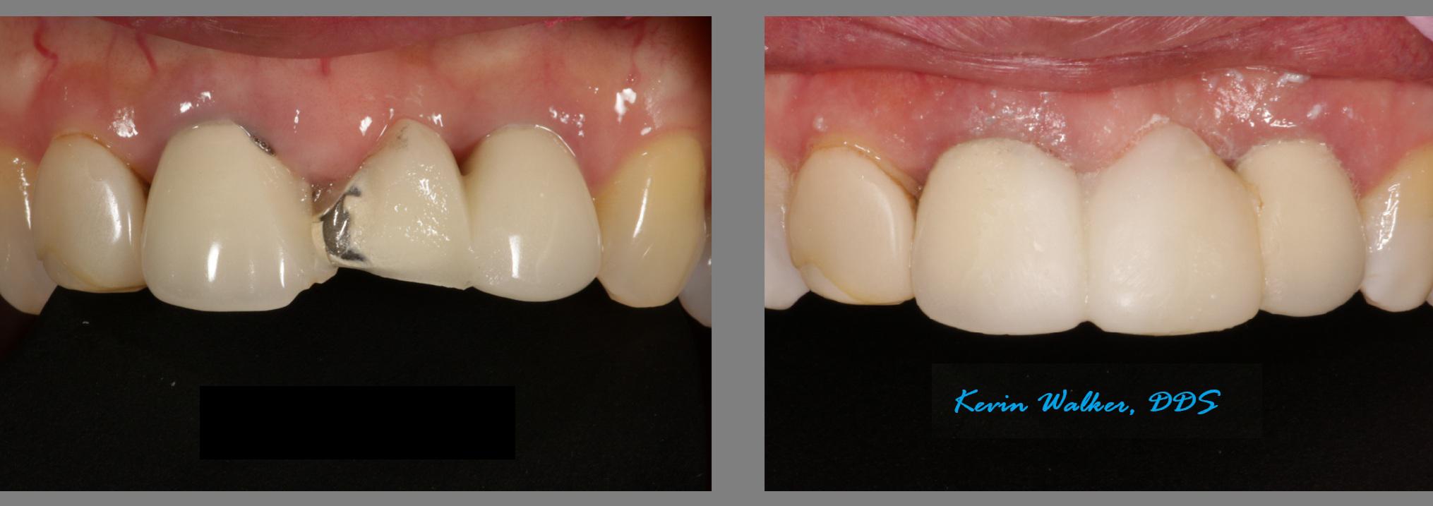 before and after picture of repaired porcelain dental fixture